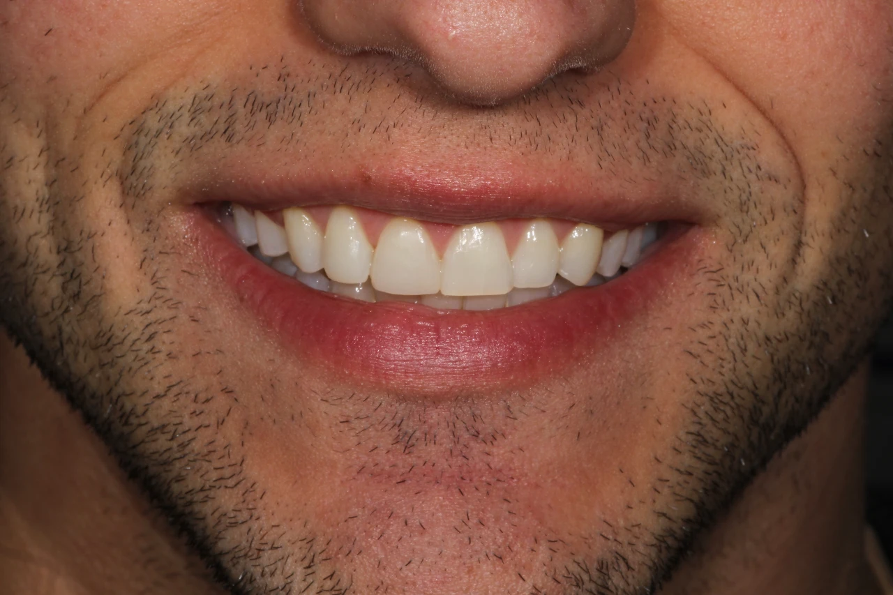 caso di bonding dentale 24 marzo dopo