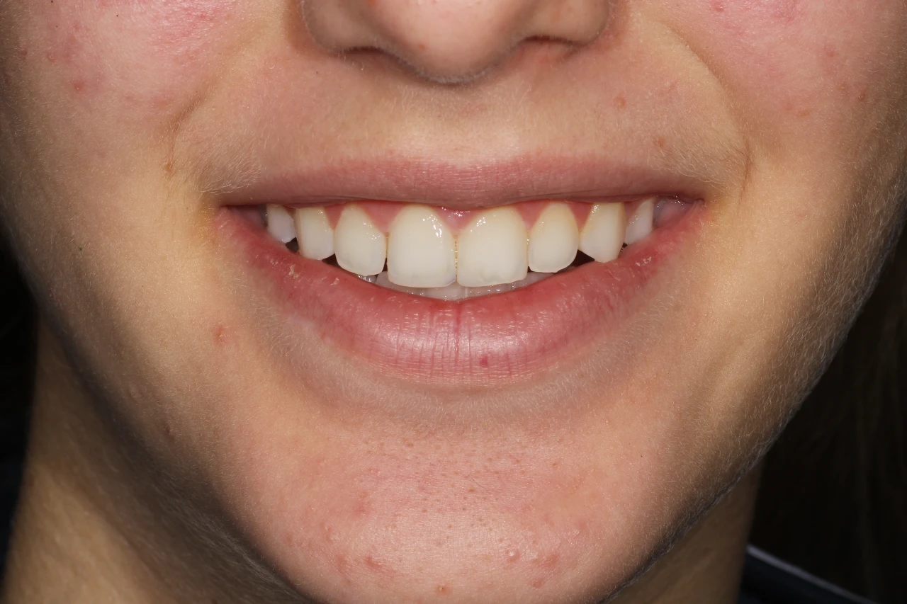 caso di bonding dentale 25 marzo dopo