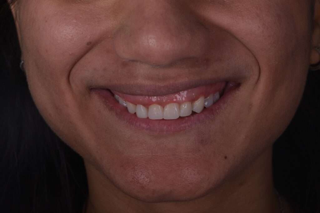 Flow Injection Technique a Milano senza limare i denti 2 flow injection dopo