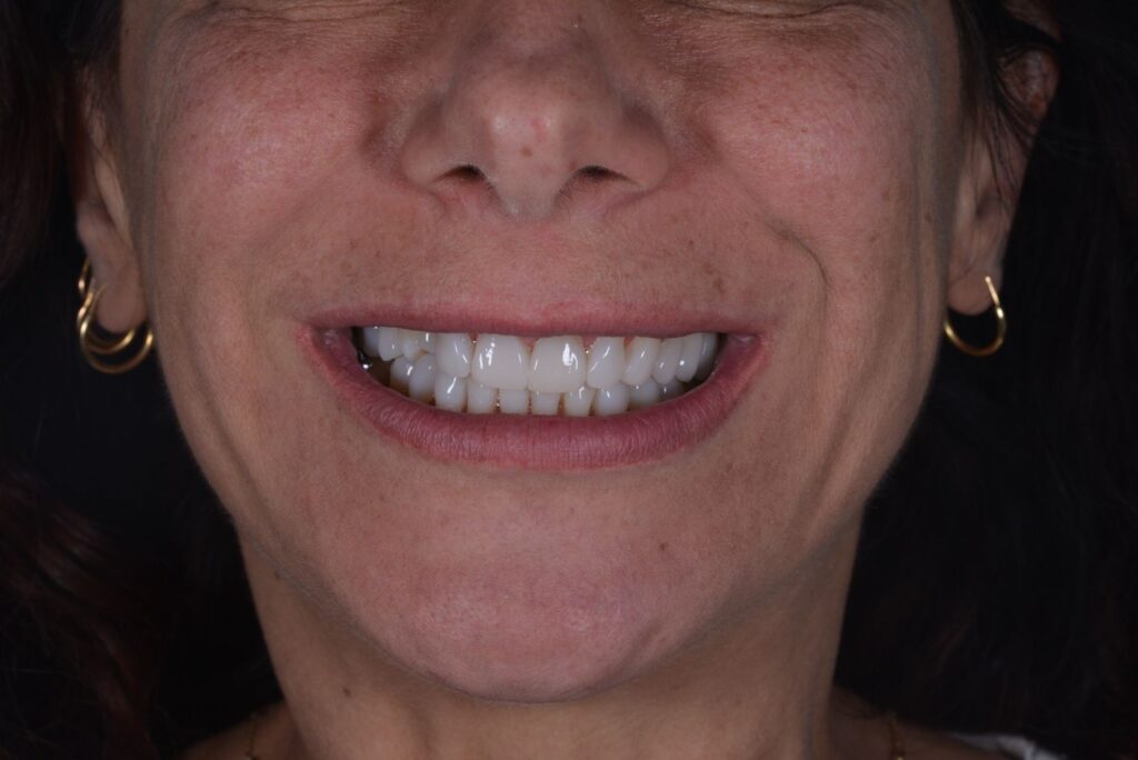 Flow Injection Technique a Milano senza limare i denti 4 flow injection dopo caso 2