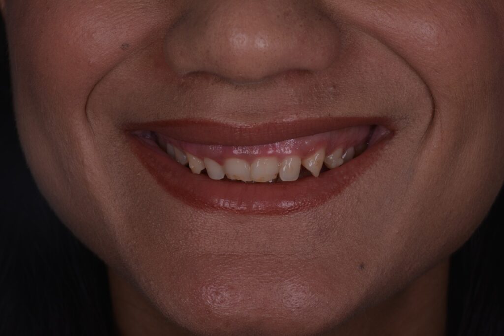 Flow Injection Technique a Milano senza limare i denti 1 flow injection prima