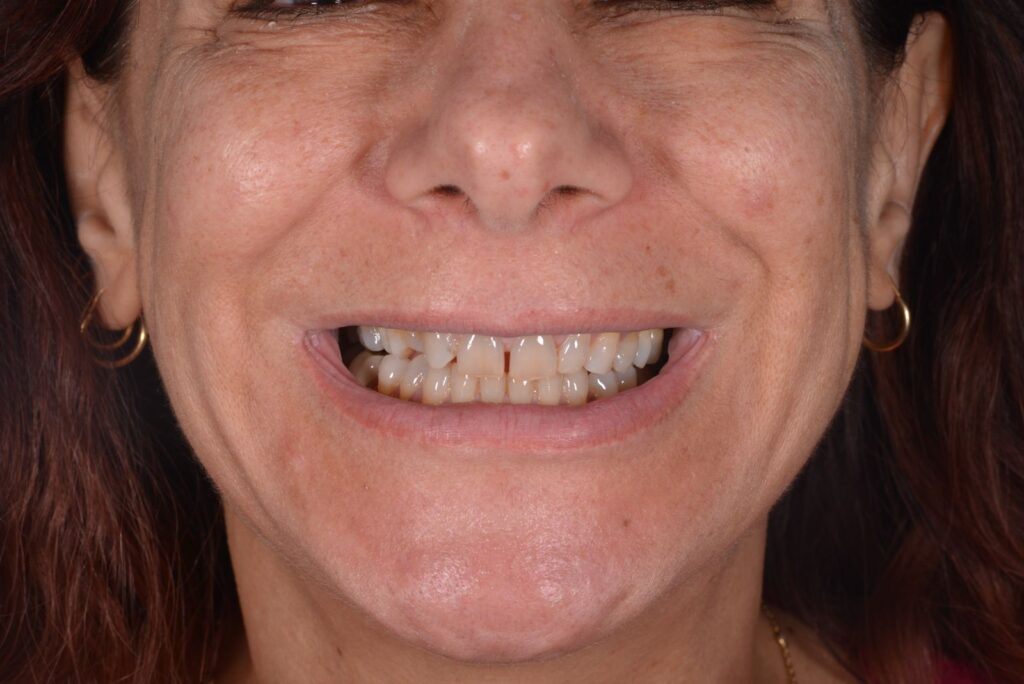 Flow Injection Technique a Milano senza limare i denti 3 flow injection prima caso 2