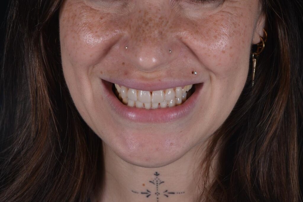 Flow Injection Technique a Milano senza limare i denti 7 flow injection dopo caso 3