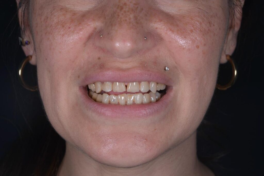 Flow Injection Technique a Milano senza limare i denti 6 flow injection prima caso 3